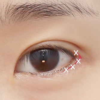 开双眼角