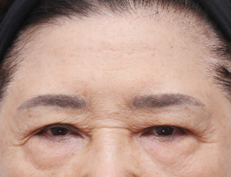 内视镜下的眉毛提升术