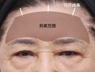 内视镜下的眉毛提升术