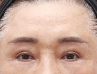 内视镜下的眉毛提升术
