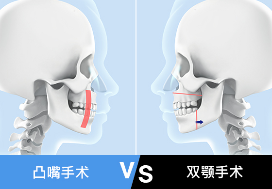 돌출입수술 VS 양악수술