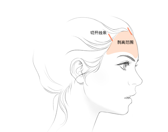 절개라인