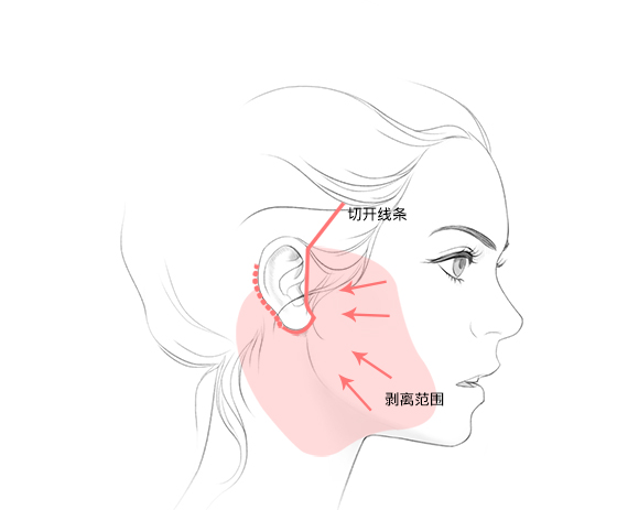 절개라인