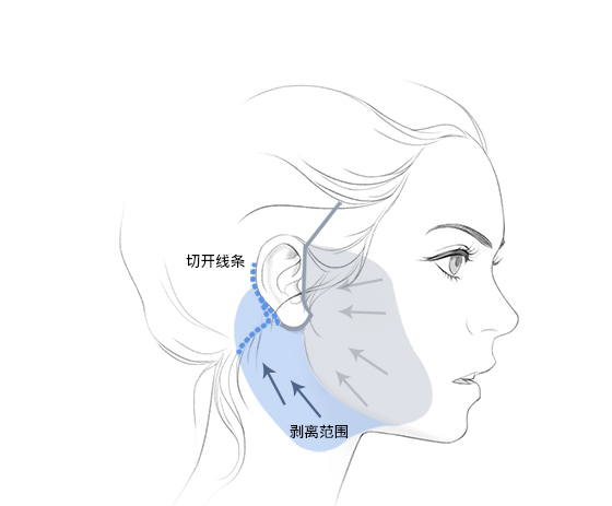 절개라인