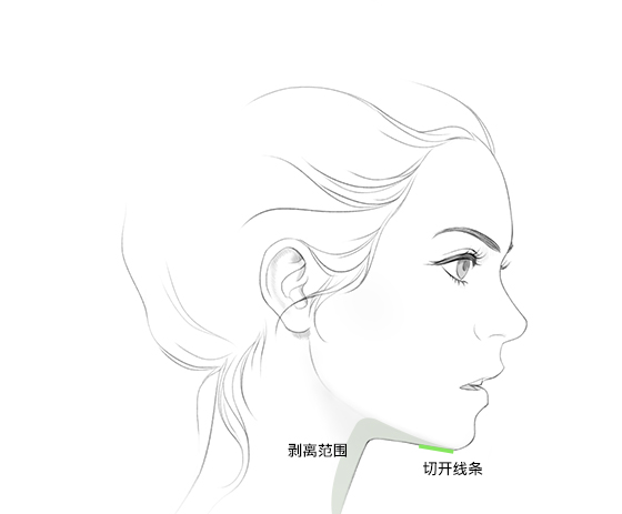 절개라인
