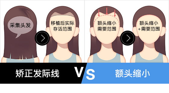 헤어라인고정 VS 이마축소고정